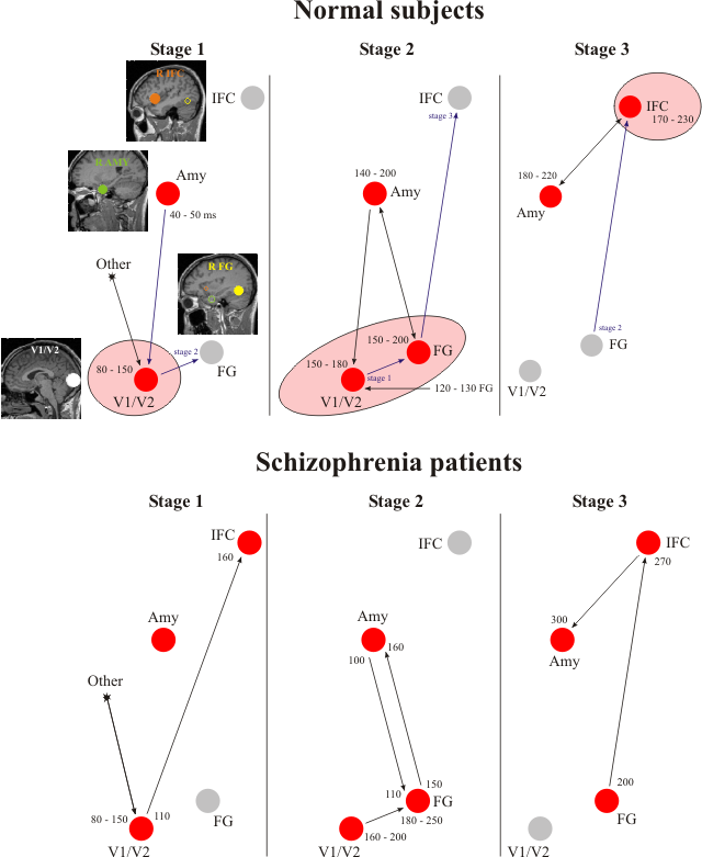 Schizophrenia brain network