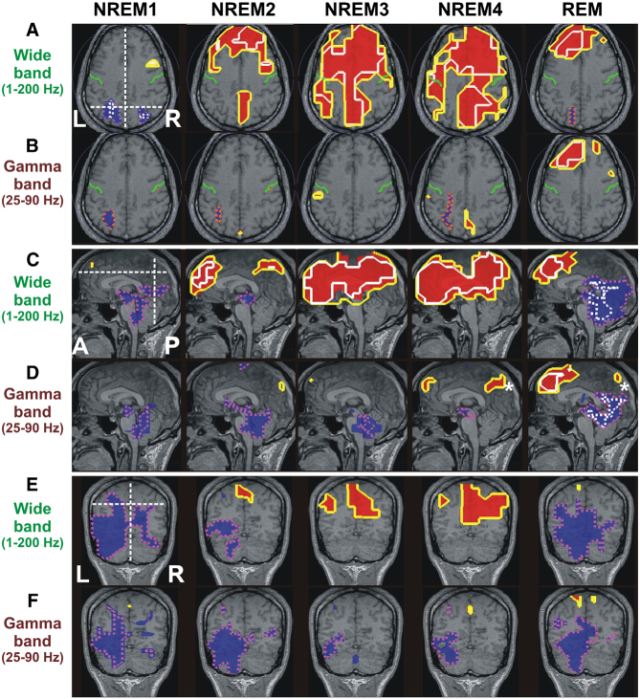 Brain activity across sleep stages